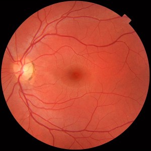 600px-Fundus_photograph_of_normal_left_eye-1