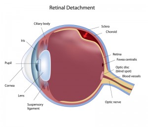 retinal detachment huntington beach ca 92647