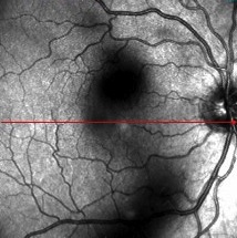 Eye before Floater Vitrectomy | Jerry Sebag MD Huntington Beach CA