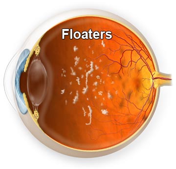 What are Floaters | Treatment of Floaters